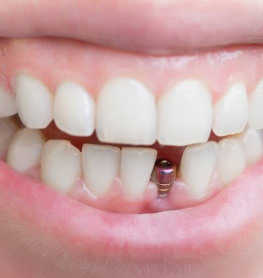 Smile with dental implant