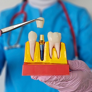 Dentist holding the crown of a dental implant