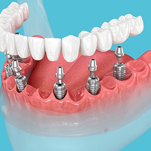 Implant dentures are a more secure, permanent type of denture than traditional dentures