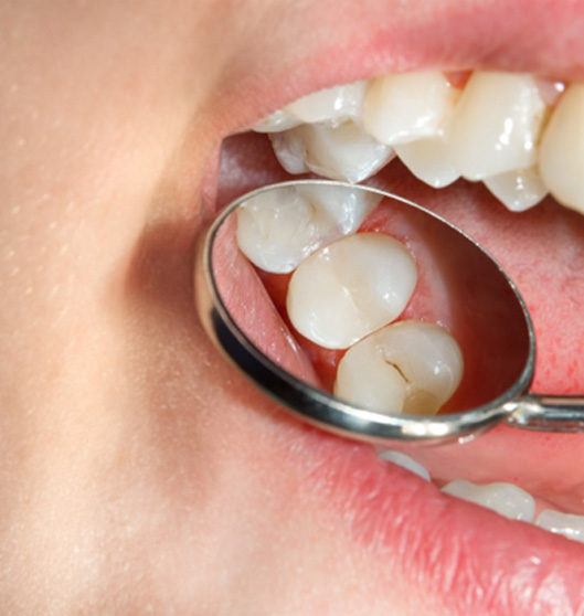 Close-up of natural-looking white filling in Rowlett 