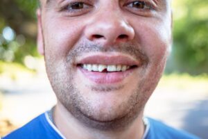 Man smiling with chipped front tooth.