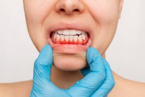 Gloved hand pulling down person’s lower lip to expose gums